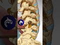 posterior lumbar interbody fusion 4k 3d animation