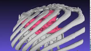 MICS（Simulation of minimally invasive mitral valve replacement）