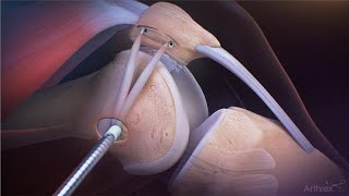 MPFL Reconstruction Using 3.9 mm BioComposite SwiveLock® Implant Kits