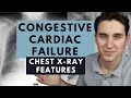 Heart failure on chest X-ray - How to recognise congestive cardiac failure and pulmonary oedema