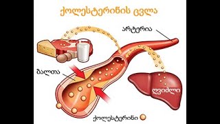 რა არის ქოლესტერინი და მავნებელია თუ არა ის. ვებინარი 5