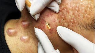 Deep blackheads removal new, big pimple pop up, blackheads extraction 2021 newest #blackheads #acne