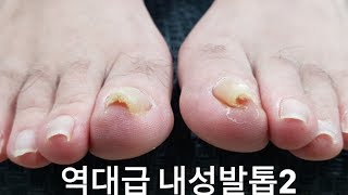 [시원함주의!!]😱정말 극한으로 말린 내성발톱 교정 영상!😨 왕건이 계속 등장!! ㅎㄷㄷ😆(ingrown toenail / toenails with fungus)