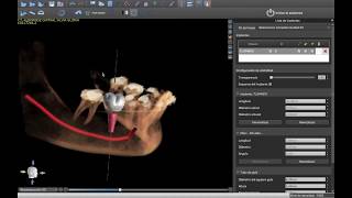 Tutorial 8 blue sky plan en español  Simulacion de implante