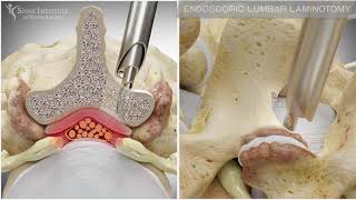 Endoscopic Lumbar Laminotomy | Spine Institute of North America