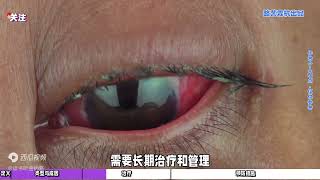 红眼病全解析：症状、成因与防治