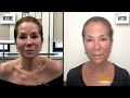 Kathie Lee Loves the Aerolase NeoSkin Rejuvenation Treatment