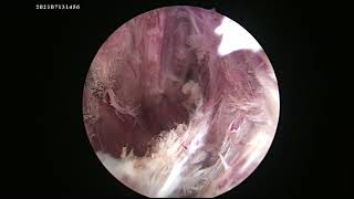 Laser Surgery for Pilonidal Sinus