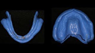 border molding and final impression for complete denture