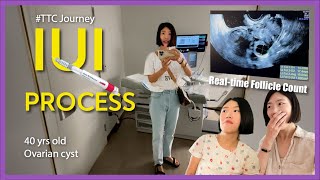 IUI with Gonal F injections - I documented my IUI  journey and shared tips & info #ttcjourney at 40