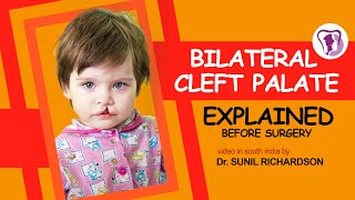 Bilateral cleft palate explained before surgery - video by Dr. Sunil Richardson