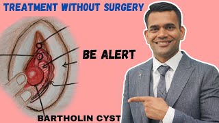 Bartholin Cyst Treatment Without Surgery | Bartholin Cyst Different Stages and Natural Treatment