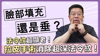 法令紋超顯老！臉部填充還是垂？拉皮手術消除超深法令紋!｜林敬鈞醫師｜巨星整形外科