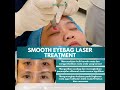 Bye Bye Puffy Eyes!~ Smooth Eyebag Laser | Rawatan Hilangkan Eyebag #eyebags  #eyetreatment