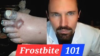 Frostbite 101 The Basics
