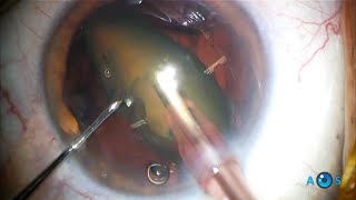 Phaco Carousel: Real-time Surgery for Soft Cataract