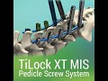 Genesys Spine: TiLock XT Minimally Invasive Pedicle Screw System