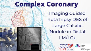 Imaging Guided RotaTripsy DES of Large Calcific Nodule in Distal LM/LCx