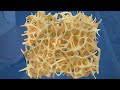 Social Care TV - Osteoporosis - Preview Clip