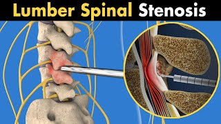 MILD procedure of lumber spinal stenosis (3D animation)