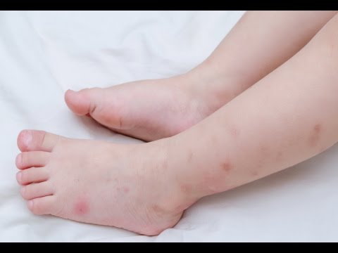 How to Treat Flea Bites on Babies How to Treat Flea Bites on Babies