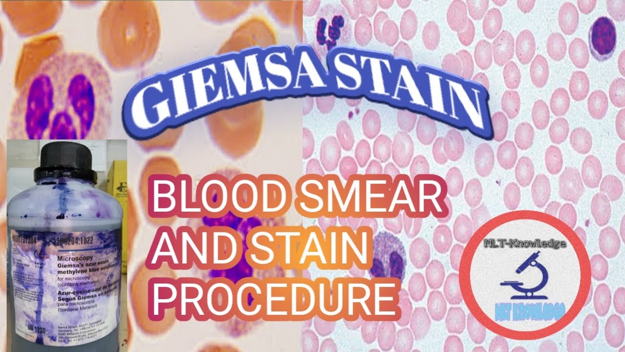 BLOOD SMEAR & GIEMSA STAIN PROCEDURE - YouTube