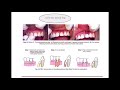 periodontal flap