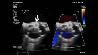 Aortic Paravalvular Leak Closure
