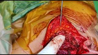 Total Conservative Parotidectomy for Pleomorphic Adenoma of Deep Lobe. Anatomy and Technique  video