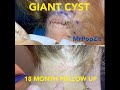 Follow Up Alert! My very first video uploaded, 18 month follow up. Giant neck cyst, minimal scar.