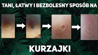 Domowy sposób na kurzajkę (łatwy, tani i bezbolesny).