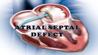ATRIAL SEPTAL DEFECT (ASD) - TYPES , HEMODYNAMICS, HEART SOUND - ASD, INVESTIGATION, MANAGEMENT