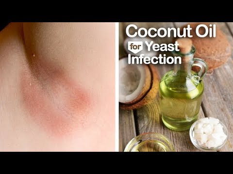 How To Cure A Yeast Infection Naturally At Home Using Coconut Oil How To Cure A Yeast Infection Naturally At Home Using Coconut Oil