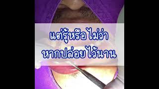 ลดกลิ่นปากง่ายๆ ด้วยการขูดหินปูน | ใช้ประกันสังคม ไม่ต้องสำรองจ่าย | ทันตกรรมฟ้าใส ระยอง