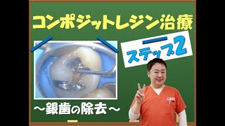 コンポジットレジン治療の流れ②【王子本町歯科クリニック】