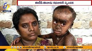 ETV Andhra Pradesh Story Effect | Badvel Boy Suffered with Rare Disease | RDO Venkatramana Helps