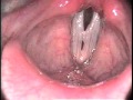 Stroboscopy: Variety Of Vocal Cord Polyps