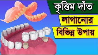 দাঁত লাগানোর বিভিন্ন পদ্ধতি  || Krittim Dat Lagana || Dat Lagano || Implant Teeth In Bangla ||