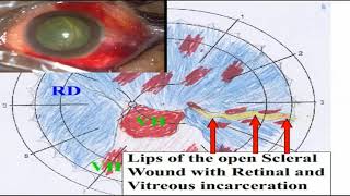 AIOC2018 - VT1 - Ocular Trauma When the Going Gets Tough