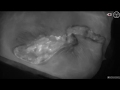 SPY-PHI Guided Debridement of Breast Tissue