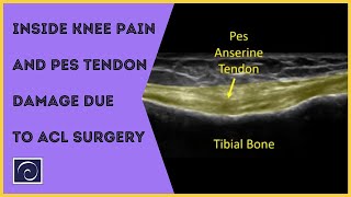 Inside Knee Pain and Pes Tendon Damage due to ACL Surgery