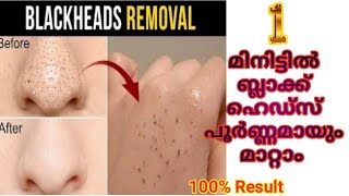 Black heads removal tips/ ബ്ലാക്ക് ഹെഡ്‌സ് പൂർണ്ണമായും മാറാൻ