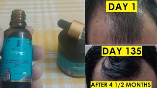 I Tried Pilgrim Hair Serum For 4+ Months. This Is The Result!