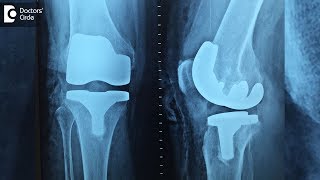 What can you expect after Knee Replacement Surgery? - Dr. Bala Murali Krishnan