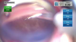 Hydrus microstent revision - clearing a blocked stent