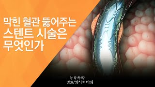 막힌 혈관 뚫어주는 스텐트 시술은 무엇인가 - (2011.4.9_368회 방송)_갑자기 마주치는 죽음의 공포, 심장 돌연사