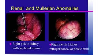 Grand Rounds- Mullerian Variants Part 1