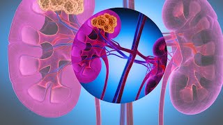 Toxicity Management in Advanced Renal Cell Carcinoma: Immunotherapy Insights