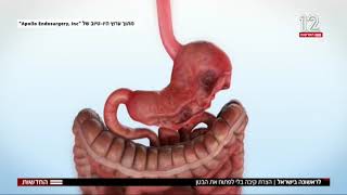 טיפול חדשני באיכילוב:  קיצור קיבה ללא ניתוח