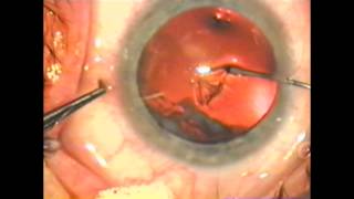 direct puncture capsulorhexis with narration